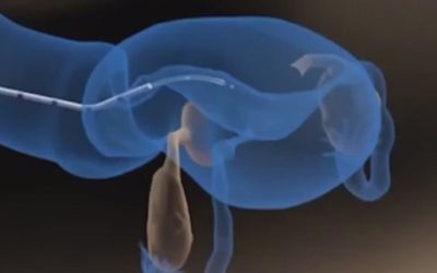 10. The Embryo Transfer Procedure
